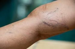 I have visible spider veins – where do I seek spider treatment in NYC or Long Island?