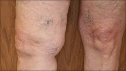 Can you treat spider veins with topical ointments or home remedies?