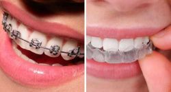 Braces Teeth Alignment Treatment