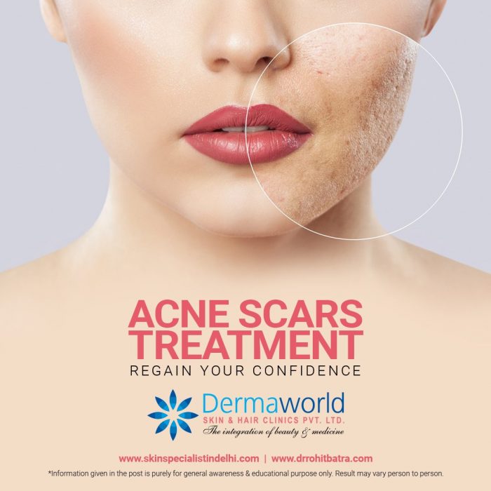 Acne scar treatment in Delhi