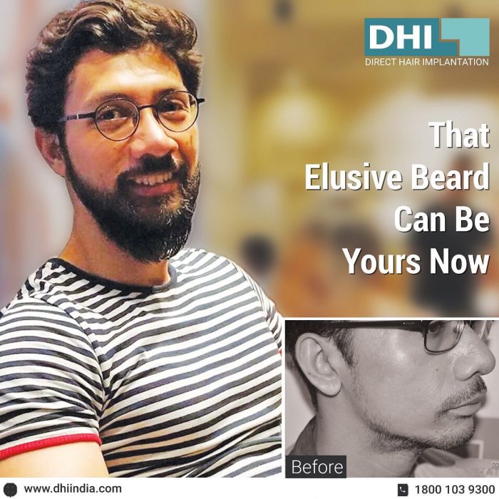 Beard Transplant in Bangalore – DHI India