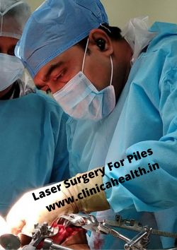 Best Laser surgery Treatment For Piles in Kolkata
