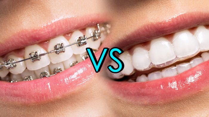 What is the Best Option of Braces for Adults? | Ivanov Orthodontic Experts