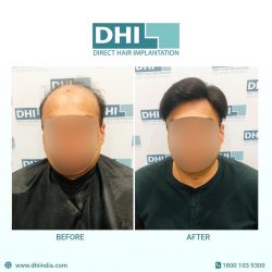 Hair Transplant Cost in Bangalore – DHI India