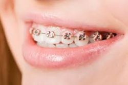 What are the Best Braces for Adults in Miami Shores? | Ivanov Orthodontic