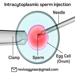 What is Intracytoplasmic sperm injection in IVF?