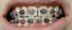 WHAT IS THE PROCESS OF GETTING BRACES BY AN ORTHODONTIST?