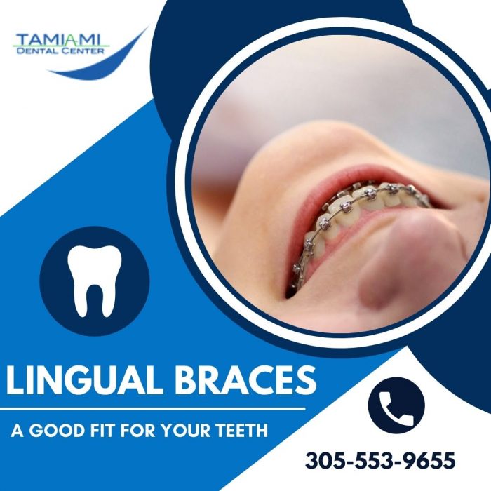 The Best Alternative for Traditional Metal Braces