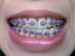 ORTHODONTIC CARE AND DENTAL INSURANCE