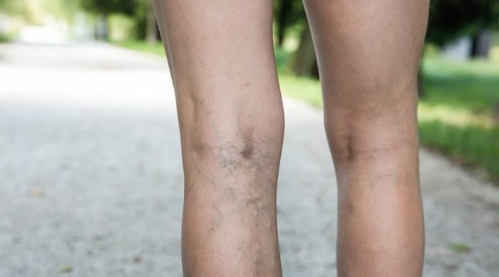 Varicose Veins the Treatment are Near Me