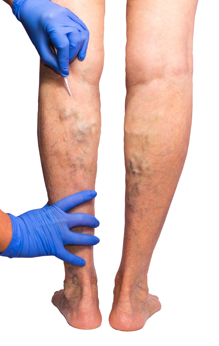 Vein Treatment are the Center in the Near Me