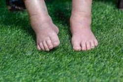 Risk Factors for Leg Swelling