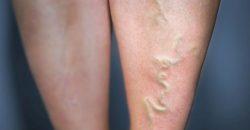 Harvard Trained Vein Doctors | Vein Center