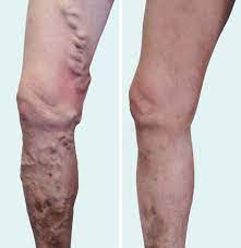 Varicose Veins Surgery Treatment