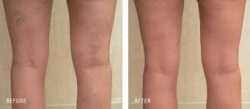 Sclerotherapy at Laser Vein Removal Center