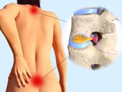 Why Are Surgery and Narcotics Ineffective Low Back Pain Treatments?