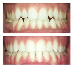 Orthodontics – Dental Options