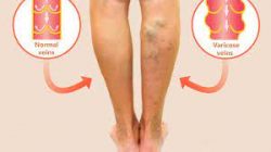 Specializing in Varicose Veins Treatment