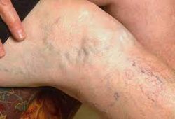 Vein doctor diagnoses chronic venous insufficiency