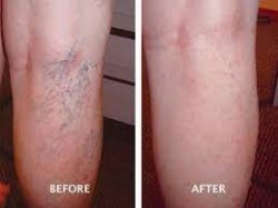 Spider vein treatment Chicago: Is sclerotherapy enough?