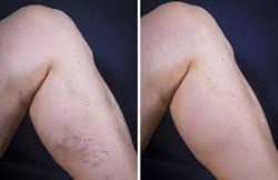 How to Get Rid of Varicose Veins?