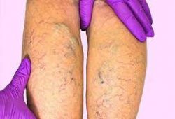 Why do I need to visit a vein clinic if I have venous insufficiency?