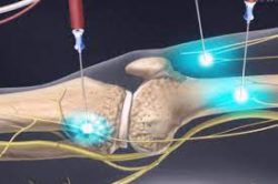 What actually happens during the RF ablation procedure?