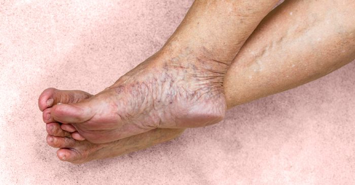 When you have chronic venous insufficiency