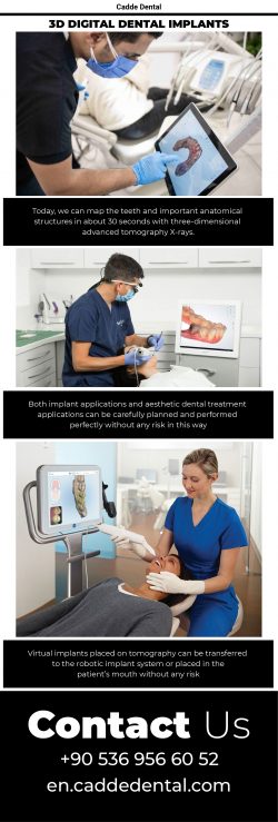 3d digital dental implants – Cadde Dental