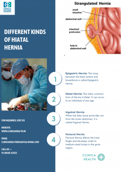 Different Kinds of Hiatal Hernia | Clinicahealth