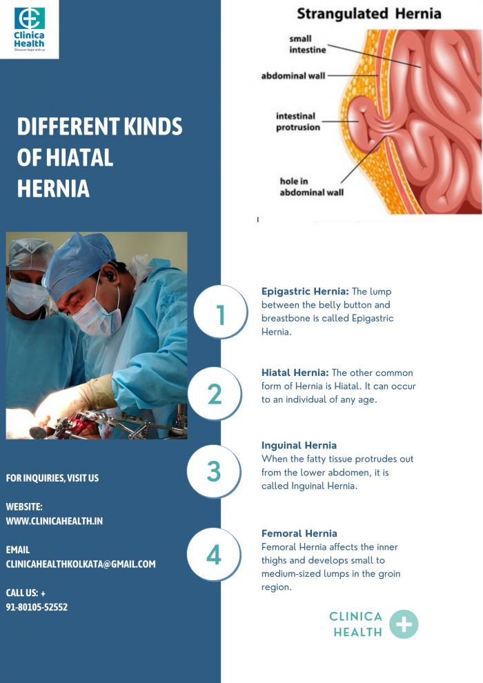 Different Kinds of Hiatal Hernia | Clinicahealth