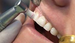 DISADVANTAGES OF DEEP CLEANING TEETH