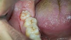 WHAT CAUSES WISDOM TOOTH PAIN?