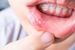 HOW CAN I TREAT CANKER SORES?
