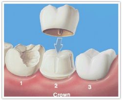 Dental Crowns Houston