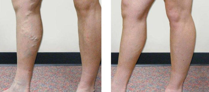 Diagnosis of Vein Disease before Treatment