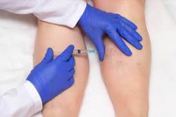 Perform minimally invasive treatment for varicose veins and spider veins