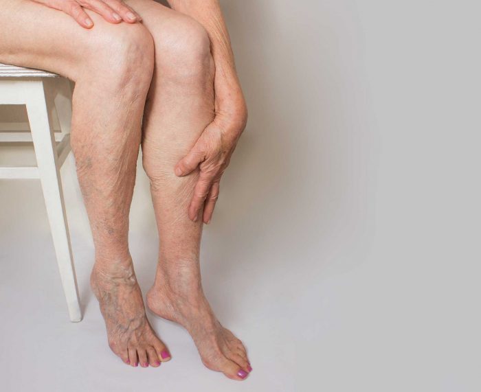 Advanced Spider and Varicose Vein Treatment Clinic