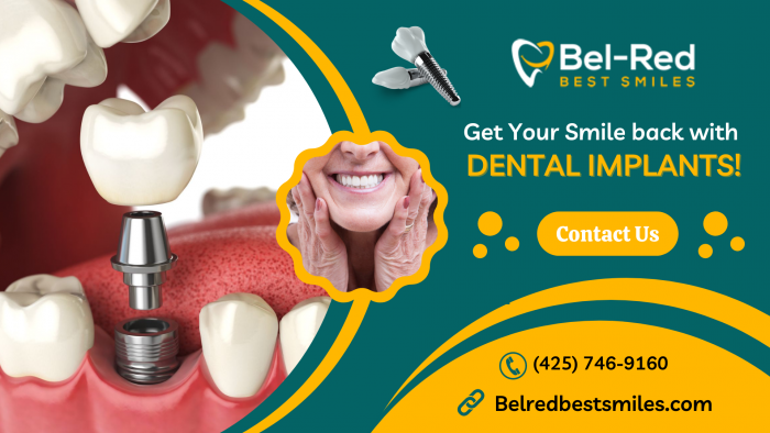 Smile Confidently with Dental Implants Treatment!