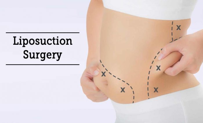 Best Liposuction Surgeon in Delhi | Dr. Vivek Kumar