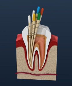 Emergency Root Canal Near Me
