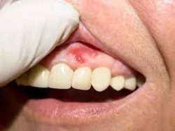 Gum Disease Treatments Houston