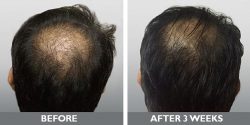 Hair Fall Treatment Chennai – Orange Clinic
