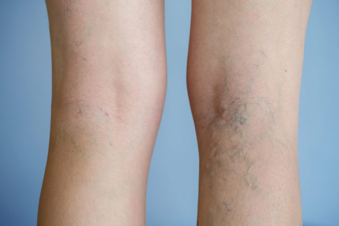How to Get Rid of Varicose Vein?