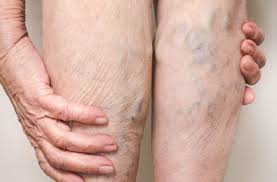 Vein Treatment Clinic has some of the best vein specialists in New York