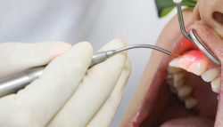 Laser Gingivectomy Treatments Near Me
