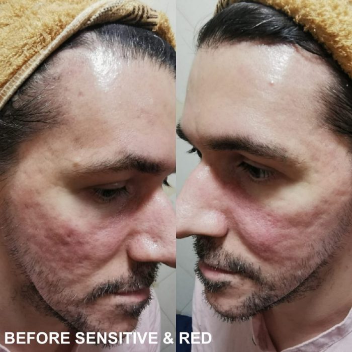 Best Treatment For Facial Scars In Singapore