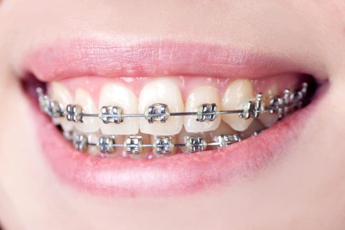 The Best Teeth Straightening Options For Adults