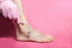 Are varicose veins bad during pregnancy?