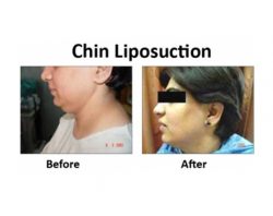 Best Liposuction Surgeon in Delhi, India | Dr. Vivek Kumar